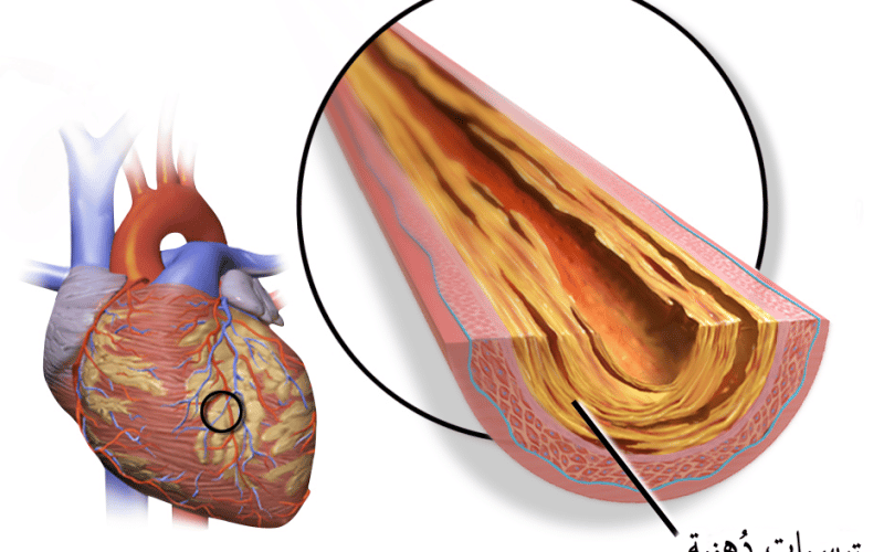 أسباب وأعراض وطرق علاج مرض الشريان التاجي
