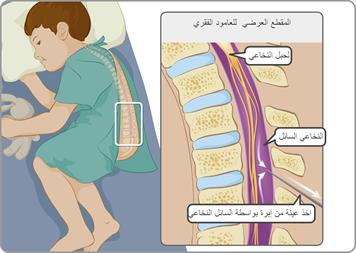 ما هو التهاب السحايا؟ وما هي اسبابه واعراضه وطرق علاجه؟