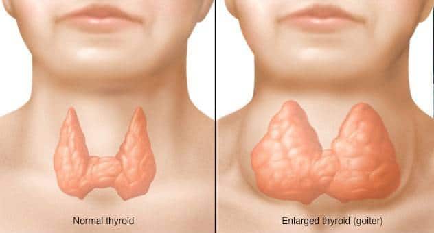 امراض تسبب تضخم الغدة الدرقية وهذه هي مخاطر استمرار تضخمها