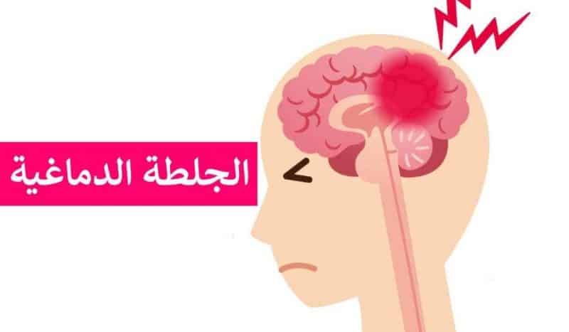 اعراض تؤكد قرب حدوث الجلطة الدماغية