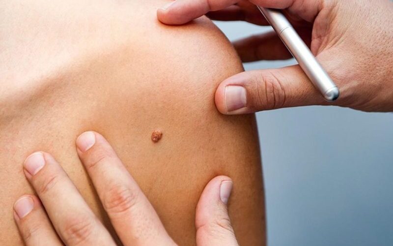 6 علامات تظهر على الجلد ويراها الكثيرين أمراً عادياً لكنها في الحقيقة إنذار مبكر للإصابة بالسرطان